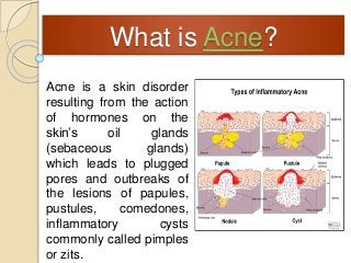 What is Acne?
Acne is a skin disorder
resulting from the action
of hormones on the
skin’s oil glands
(sebaceous glands)
which leads to plugged
pores and outbreaks of
the lesions of papules,
pustules, comedones,
inflammatory cysts
commonly called pimples
or zits.
 