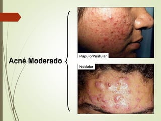 Papulo/Pustular
Nodular
Acné Moderado
 