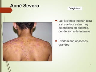 Conglobata
1
Acné Severo
 Las lesiones afectan cara
y el cuello y estan muy
extendidas en eltornco,
donde son más intensas
 Predominan abscesos
grandes
 