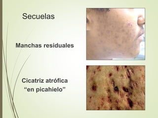 Secuelas
Manchas residuales
Cicatriz atrófica
“en picahielo”
 