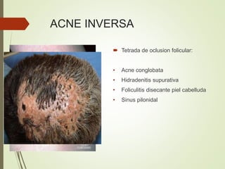 ACNE INVERSA
 Tetrada de oclusion folicular:
• Acne conglobata
• Hidradenitis supurativa
• Foliculitis disecante piel cabelluda
• Sinus pilonidal
 