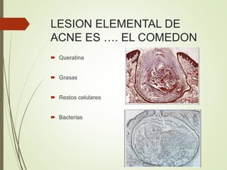 LESION ELEMENTAL DE
ACNE ES …. EL COMEDON
 Queratina
 Grasas
 Restos celulares
 Bacterias
 