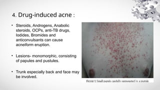 Acneiform Rash Back an overview of ACNE and its treatment pptx1.pptx