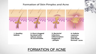 an overview of ACNE and its treatment pptx1.pptx
