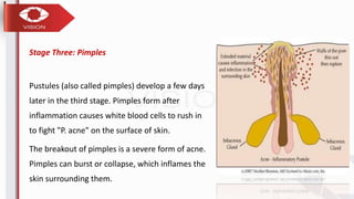 Acne-prone skin & oily skin | PPTX