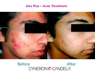 elos Plus – Acne Treatment
 