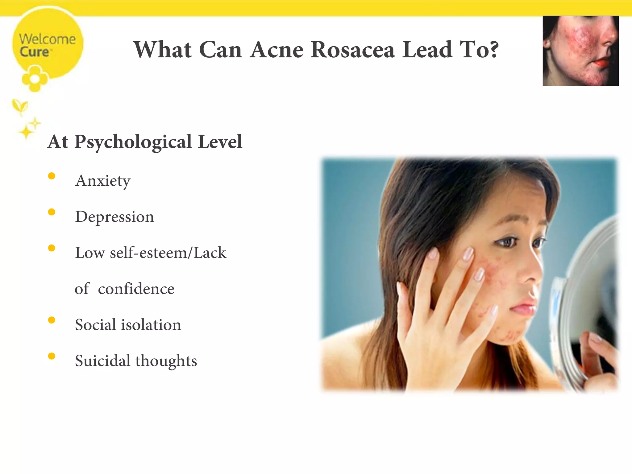 Acne Rosacea- The Disease, Its Complications And Homeopathic Treatment ...