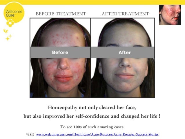 Acne Rosacea- The Disease, Its Complications And Homeopathic Treatment Acne Rosacea- The Disease, Its Complications And Homeopathic Treatment