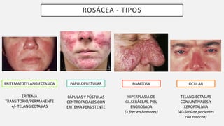 ROSÁCEA - TIPOS
ERITEMATOTELANGIECTASICA PÁPULOPUSTULAR
ERITEMA
TRANSITORIO/PERMANENTE
+/- TELANGIECTASIAS
PÁPULAS Y PÚSTULAS
CENTROFACIALES CON
ERITEMA PERSISTENTE
OCULAR
TELANGIECTASIAS
CONJUNTIVALES Y
XEROFTALMIA
(40-50% de pacientes
con rosácea)
FIMATOSA
HIPERPLASIA DE
GL.SEBÁCEAS. PIEL
ENGROSADA
(+ frec en hombres)
 