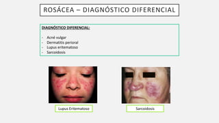ROSÁCEA – DIAGNÓSTICO DIFERENCIAL
DIAGNÓSTICO DIFERENCIAL:
- Acné vulgar
- Dermatitis perioral
- Lupus eritematoso
- Sarcoidosis
Lupus Eritematoso Sarcoidosis
 