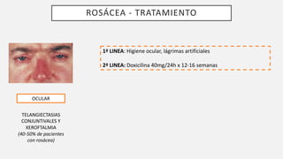ROSÁCEA - TRATAMIENTO
OCULAR
TELANGIECTASIAS
CONJUNTIVALES Y
XEROFTALMIA
(40-50% de pacientes
con rosácea)
1ª LINEA: Higiene ocular, lágrimas artificiales
2ª LINEA: Doxicilina 40mg/24h x 12-16 semanas
 