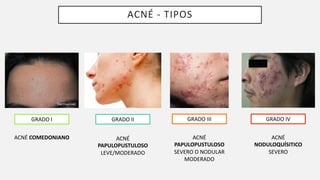 ACNÉ - TIPOS
GRADO I GRADO II GRADO III GRADO IV
ACNÉ COMEDONIANO ACNÉ
PAPULOPUSTULOSO
LEVE/MODERADO
ACNÉ
PAPULOPUSTULOSO
SEVERO O NODULAR
MODERADO
ACNÉ
NODULOQUÍSITICO
SEVERO
 