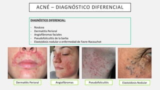 ACNÉ – DIAGNÓSTICO DIFERENCIAL
DIAGNÓSTICO DIFERENCIAL:
- Rosácea
- Dermatitis Perioral
- Angiofibromas faciales
- Pseudofoliculitis de la barba
- Elastoidosis nodular o enfermedad de Favre-Racouchot
DermaQQs Perioral Angiofibromas Pseudofoliculitis Elastoidosis Nodular
 
