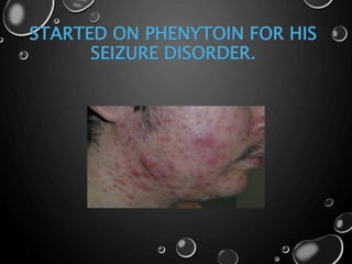 STARTED ON PHENYTOIN FOR HIS
SEIZURE DISORDER.
 