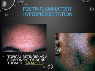 POSTINFLAMMATORY
HYPERPIGMENTATION
• TOPICAL RETINOID AS A
COMPONENT OF ACNE
THERAPY (GRADE 2B).
 