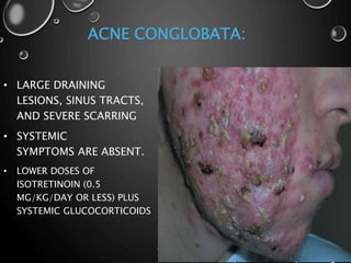 ACNE CONGLOBATA:
• LARGE DRAINING
LESIONS, SINUS TRACTS,
AND SEVERE SCARRING
• SYSTEMIC
SYMPTOMS ARE ABSENT.
• LOWER DOSES OF
ISOTRETINOIN (0.5
MG/KG/DAY OR LESS) PLUS
SYSTEMIC GLUCOCORTICOIDS
 