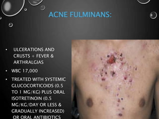 ACNE FULMINANS:
• ULCERATIONS AND
CRUSTS + FEVER &
ARTHRALGIAS
• WBC 17,000
• TREATED WITH SYSTEMIC
GLUCOCORTICOIDS (0.5
TO 1 MG/KG) PLUS ORAL
ISOTRETINOIN (0.5
MG/KG/DAY OR LESS &
GRADUALLY INCREASED)
OR ORAL ANTIBIOTICS
 