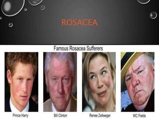 ROSACEA
 