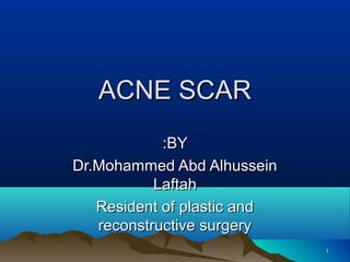 ACNE SCARACNE SCAR
BYBY::
Dr.Mohammed Abd AlhusseinDr.Mohammed Abd Alhussein
LaftahLaftah
Resident of plastic andResident of plastic and
reconstructive surgeryreconstructive surgery
11
 