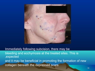 Acne scar treatment