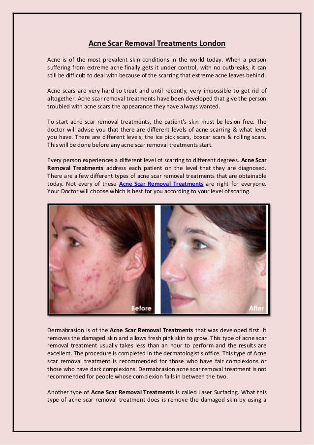 Acne Scar Removal Treatments London