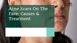 Acne Scars On The
Face: Causes &
Treatment
 