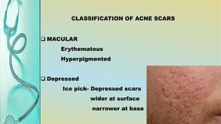surgical management of acne scars | PPTX