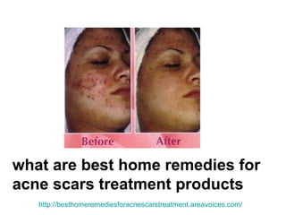 what are best home remedies for acne scars treatment products http:// besthomeremediesforacnescarstreatment.areavoices.com / 