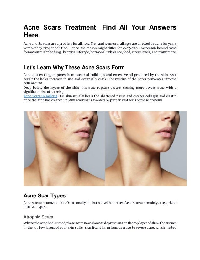 Acne Scars Treatment In Kolkata (1).pdf