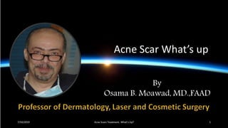 Acne scars treatment What's Up?