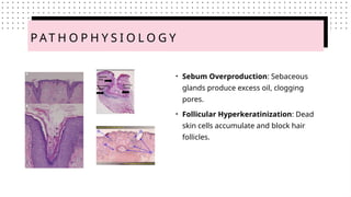 Hyperkeratinization Rabbits Acne, secretory glands and epithelia (1).pptx