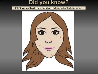 Click on each of the spots to find out a fact about acne.
 