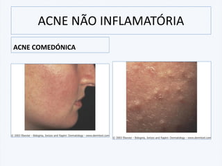 ACNE NÃO INFLAMATÓRIA
ACNE COMEDÓNICA
 
