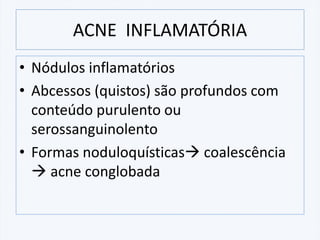 • Nódulos inflamatórios
• Abcessos (quistos) são profundos com
conteúdo purulento ou
serossanguinolento
• Formas noduloquísticas→ coalescência
→ acne conglobada
ACNE INFLAMATÓRIA
 