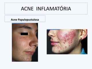 ACNE INFLAMATÓRIA
Acne Papulopustulosa
 
