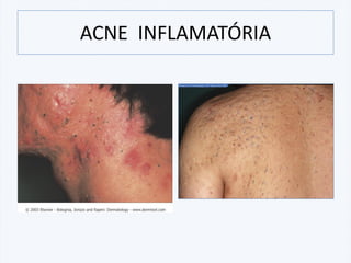 ACNE INFLAMATÓRIA
 