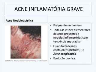 ACNE INFLAMATÓRIA GRAVE
Acne Noduloquística
• Frequente no homem
• Todas as lesões elementares
da acne presentes e
nódulos inflamatórios com
tendência supurativa
• Quando há lesões
confluentes (fístulas) →
Acne conglobada
• Evolução crónica
 