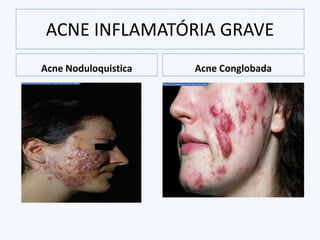 ACNE INFLAMATÓRIA GRAVE
Acne Noduloquistica Acne Conglobada
 