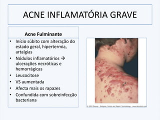 Acne Fulminante
• Início súbito com alteração do
estado geral, hipertermia,
artalgias
• Nódulos inflamatórios →
ulcerações necróticas e
hemorrágicas
• Leucocitose
• VS aumentada
• Afecta mais os rapazes
• Confundida com sobreinfecção
bacteriana
ACNE INFLAMATÓRIA GRAVE
 