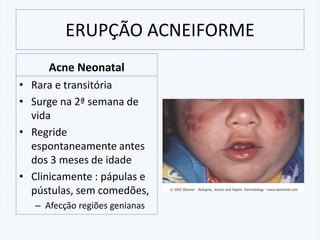 ERUPÇÃO ACNEIFORME
Acne Neonatal
• Rara e transitória
• Surge na 2ª semana de
vida
• Regride
espontaneamente antes
dos 3 meses de idade
• Clinicamente : pápulas e
pústulas, sem comedões,
– Afecção regiões genianas
 
