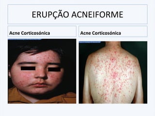 Acne Corticosónica Acne Corticosónica
ERUPÇÃO ACNEIFORME
 