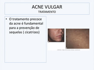 ACNE VULGAR
TRATAMENTO
• O tratamento precoce
da acne é fundamental
para a prevenção de
sequelas ( cicatrizes)
 