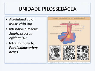 • Acroinfundíbulo:
Malassézia spp
• Infundíbulo médio:
Staphylococcus
epidermidis
• Infrainfundíbulo:
Propionibacterium
acnes
UNIDADE PILOSSEBÁCEA
 