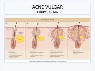 ACNE VULGAR
ETIOPATOGENIA
 