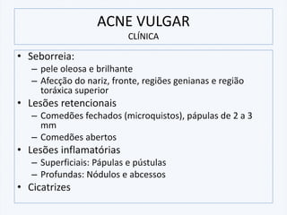ACNE VULGAR
CLÍNICA
• Seborreia:
– pele oleosa e brilhante
– Afecção do nariz, fronte, regiões genianas e região
toráxica superior
• Lesões retencionais
– Comedões fechados (microquistos), pápulas de 2 a 3
mm
– Comedões abertos
• Lesões inflamatórias
– Superficiais: Pápulas e pústulas
– Profundas: Nódulos e abcessos
• Cicatrizes
 