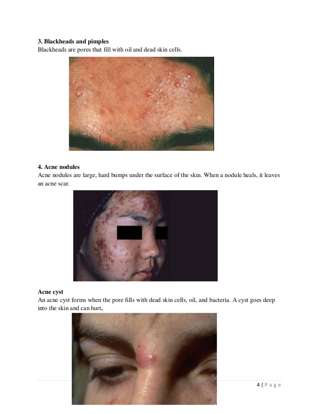 Acne vulgaris