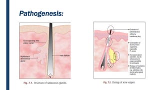 Acne vulgaris | PPTX