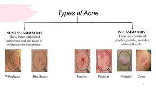 Non Inflamed acne vulgaris -Mpharm (2nd semester) Cosmetics and cosmeceuticals | PPTX