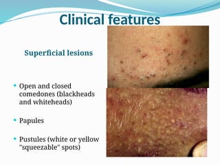 Sebaceous Pustules Acne Vulgaris is a chronic inflammatory disease of the pilosebaceous ...