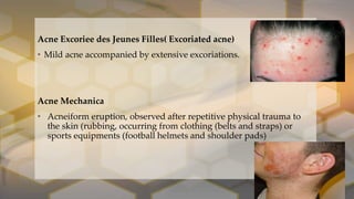 Acne vulgaris [autosaved] | PPTX